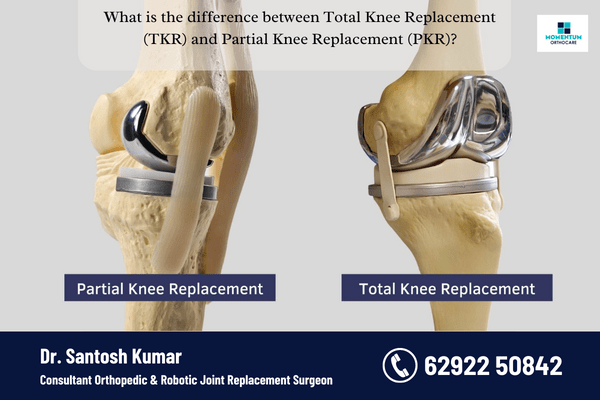What-is-the-difference-between-Total-Knee-Replacement-TKR-and-Partial-Knee-Replacement-PKR.png